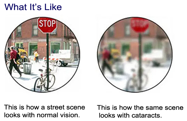 This is how a street scene looks with normal vision. This is how the same scene looks with cataracts.