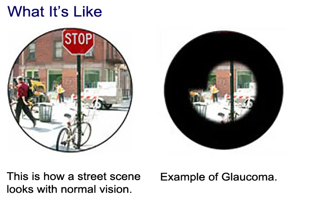 This is how a street scene looks with normal vision. Example of Glaucoma.