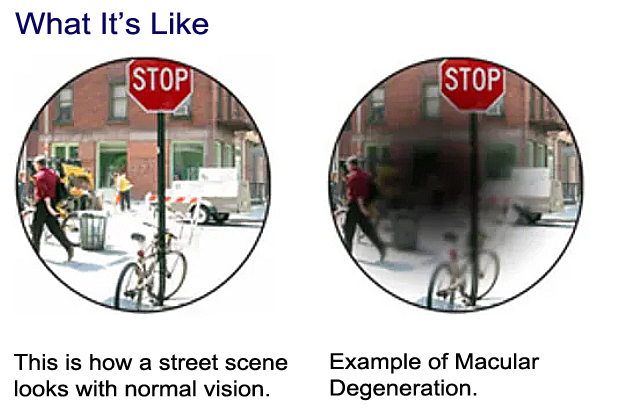 This is how a street scene looks with normal vision. Example of Macular Degeneration.